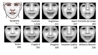 Crean un software capaz de diagnosticar trastornos genéticos por una foto