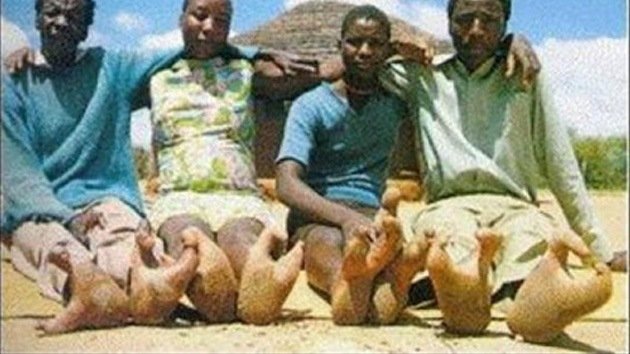 Miembros de tribu africana presentan deformación en sus pies similar a las patas de avestruz