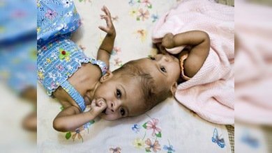 Cirujanos británicos separan a unas siamesas unidas por la cabeza