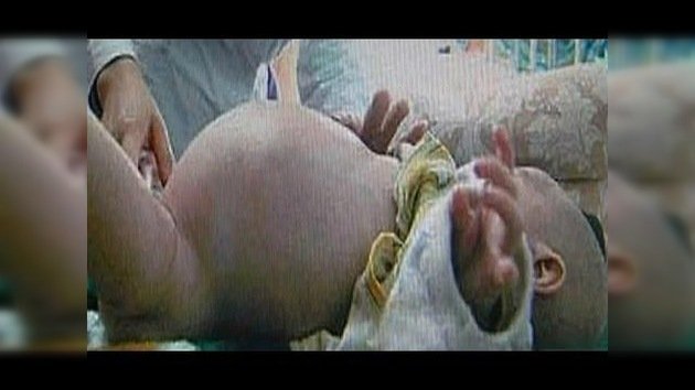 Fetus in fetu: Extirpan el  feto de su gemelo muerto a un niño chino de dos años