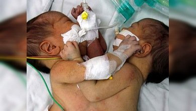 Chile: fallece una de las siamesas recientemente separadas 