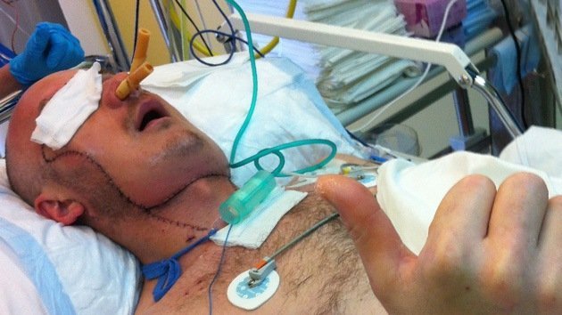 Polonia realiza el primer trasplante total de cara a un hombre accidentado en una cantera