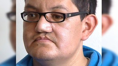 Reconstruyen en España el rostro de un hombre con una prótesis de cerámica