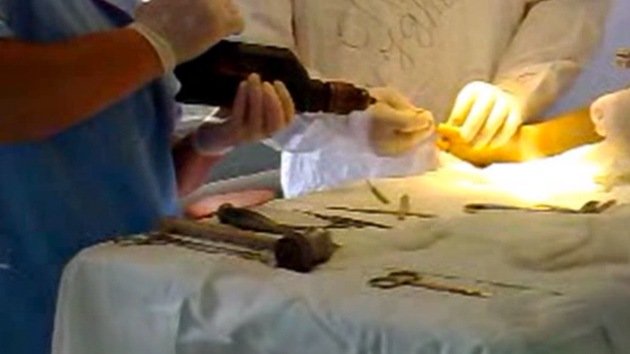 Cirujanos moldavos operan a niños utilizando herramientas de construcción