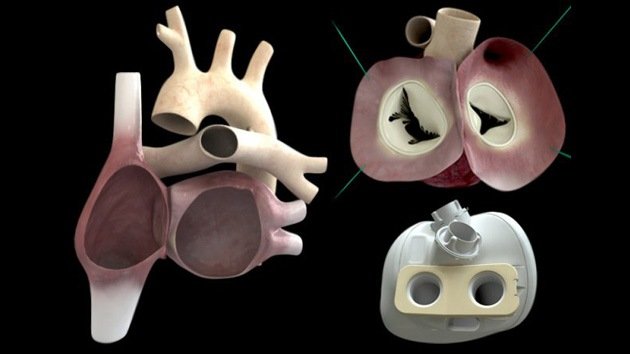 Video, Fotos: Primer trasplante de un corazón artificial