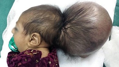 Foto: Médicos afganos extirparon una 'segunda cabeza' de un bebé