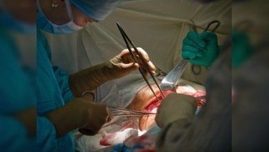 Un virus es la causa de la apendicitis