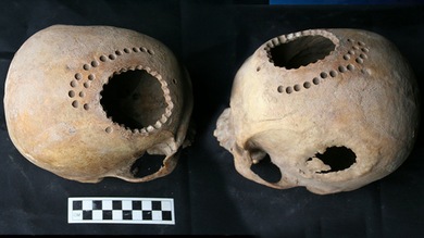 Fotos: en el antiguo Perú hacían trepanaciones craneales incluso para curar 'corazones rotos'