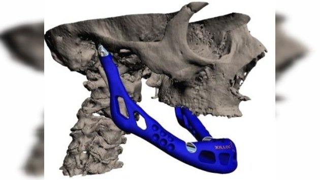 Primer implante de una prótesis fabricada con una impresora 3D