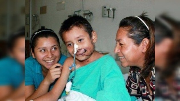Médicos mexicanos le devuelven el rostro a un niño de siete años