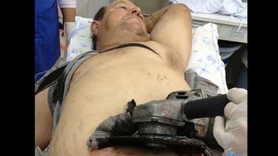 Médicos brasileños retiran una sierra circular del abdomen de un agricultor