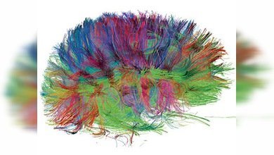 El Alzheimer ahora se puede detectar a través de un escáner cerebral