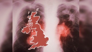 Londres, capital europea de la tuberculosis