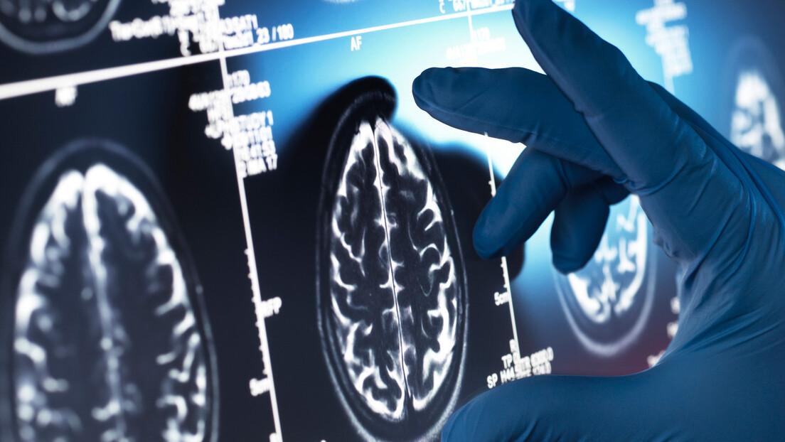 Exame inovador pode detectar Alzheimer antes dos primeiros sintomas