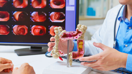 Por que o câncer de cólon cresce entre os jovens?