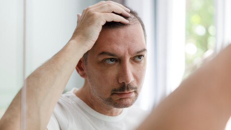 Alerta aos carecas: finasterida pode levar a depressão e suicídio