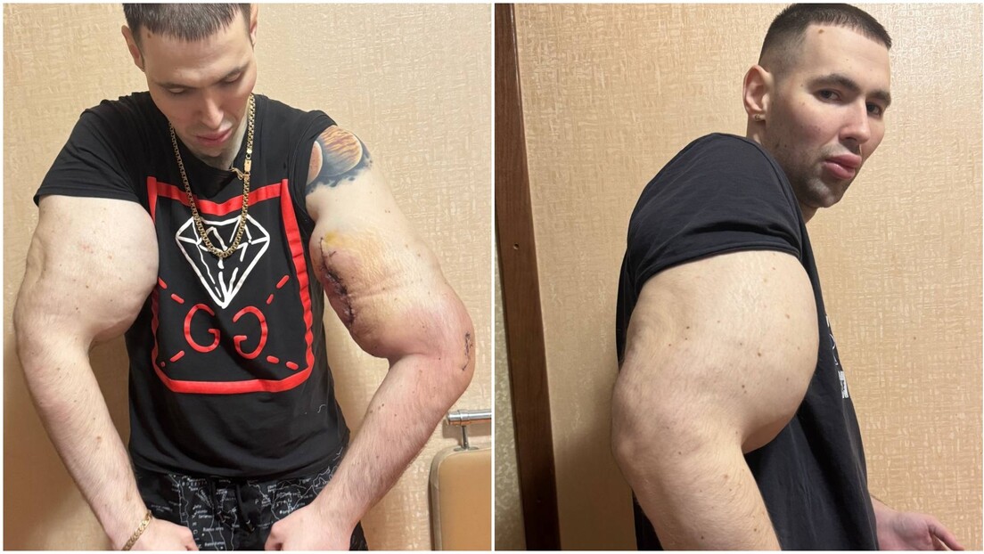 FOTOS: Blogueiro russo pode ter braços amputados após injetar substância oleosa que 'infla' músculos