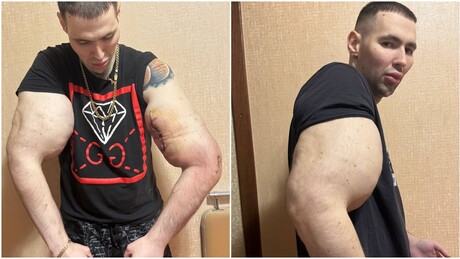 FOTOS: Blogueiro russo pode ter braços amputados após injetar substância oleosa que 'infla' músculos