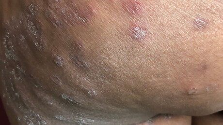 'Superfungo' altamente resistente e transmissível se espalha pelo Reino Unido