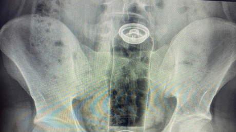 Só pro meu prazer: homem introduz desodorante no ânus e acaba internado