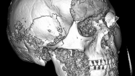'Máquina do tempo': cientistas russos descobrem evidência de cirurgia complexa feita há 2.500 anos