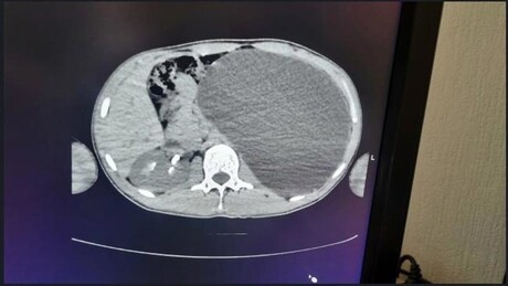 Exame de rotina revela 'bomba-relógio' que jovem russo carregava dentro de si