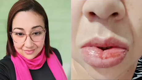 Justiça nega indenização a mulher que alegou reação alérgica após usar pasta de dente