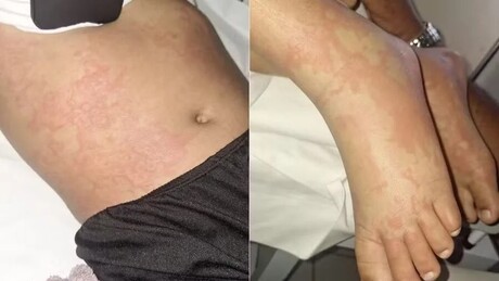 Criança é internada no RN após suspeita de contato com detergente da Ypê