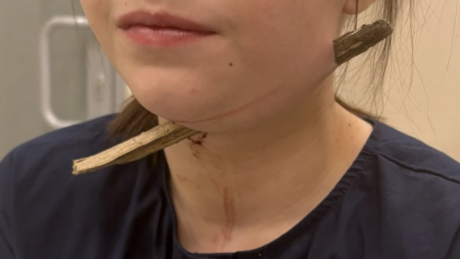 Chocante: menina cai e tem pescoço perfurado na Rússia; entenda o caso