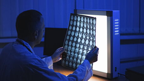 Médicos russos fazem cirurgia inédita de aneurisma cerebral