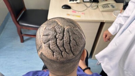 Homem conviveu por anos com condição rara que fazia seu couro cabeludo se parecer com um cérebro
