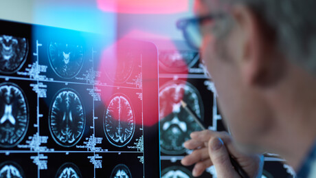 Alzheimer pode provocar alterações no cérebro antes de falhas na memória, indica estudo