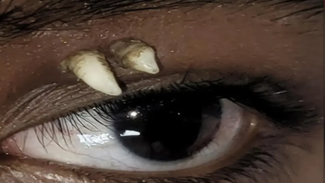 Caso inédito: dente canino cresce na órbita ocular de adolescente na Índia
