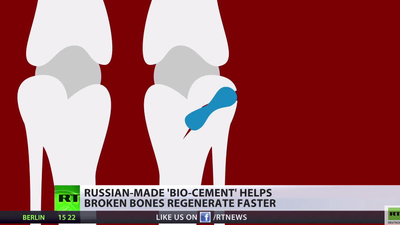 Gips adieu - Russischer Wissenschaftler erfindet regenerativen, bahnbrechenden "Knochenmörtel"
