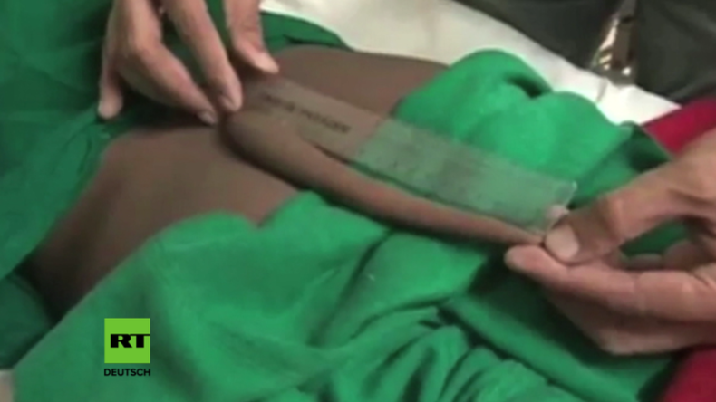 Indien: Außergewöhnliche Operation - Chirurgen entfernen 18 Zentimeter langen Schwanz von Teenager