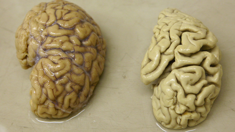 Wissenschaft: Ist Alzheimer doch ansteckend? Wettbewerb zur Ursachenforschung ausgeschrieben