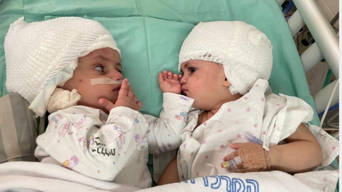 Siamesische Zwillinge nach 12-stündiger Operation in Israel erfolgreich voneinander getrennt