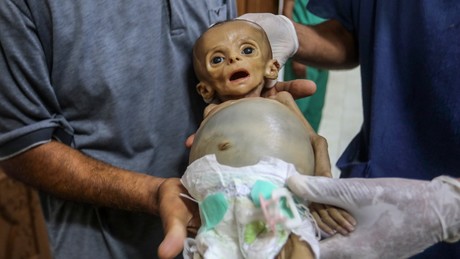 Britischer Arzt: Israel verbietet Einfuhr von Babynahrung nach Gaza und übt Schießen auf Menschen