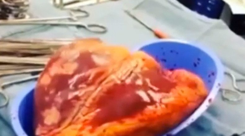 Cocaine addict's heart 'beats' for 25 mins after removal (VIDEO)