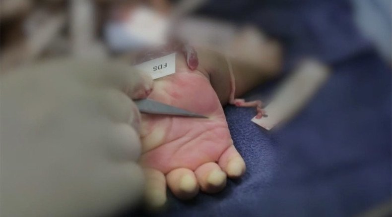 Maryland boy first to get double hand transplant (VIDEO)