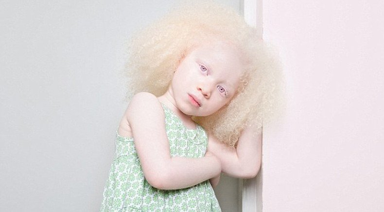 One in 20,000: Extraordinary albino beauty revealed in rare photoshoot (AMAZING PHOTOS)