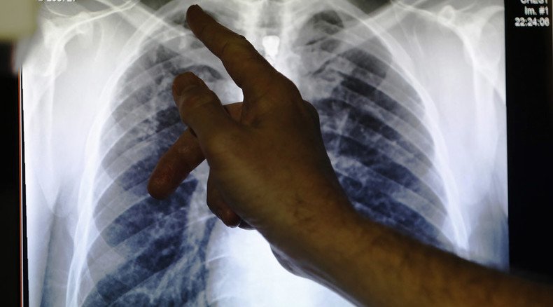 TB rates explode in London: ‘We stopped screening people for this disease’