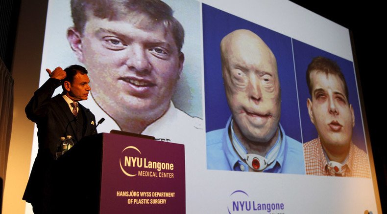 Face-transplant breakthroughs - Incredible images from a decade saving face