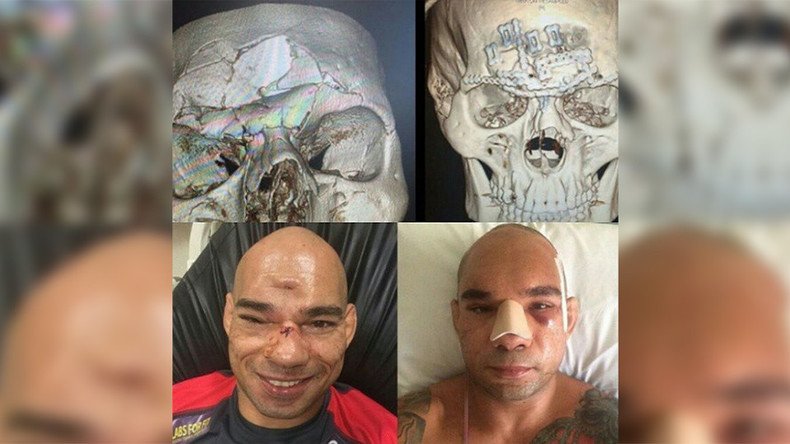 "Cyborg" Santos successfully undergoes seven-hour surgery on horrific head injury (PHOTOS)