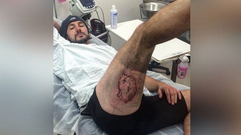 Burner phone: iPhone explodes on cyclist’s leg after fall (PHOTOS)