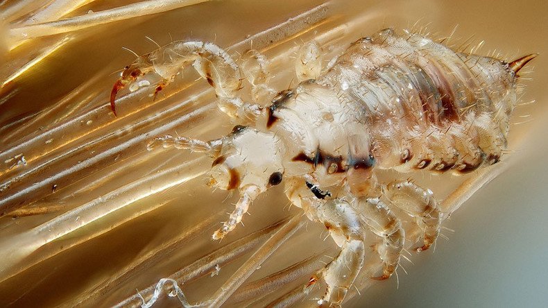 Mutant ‘super lice’ US outbreak here just in time for back-to-school