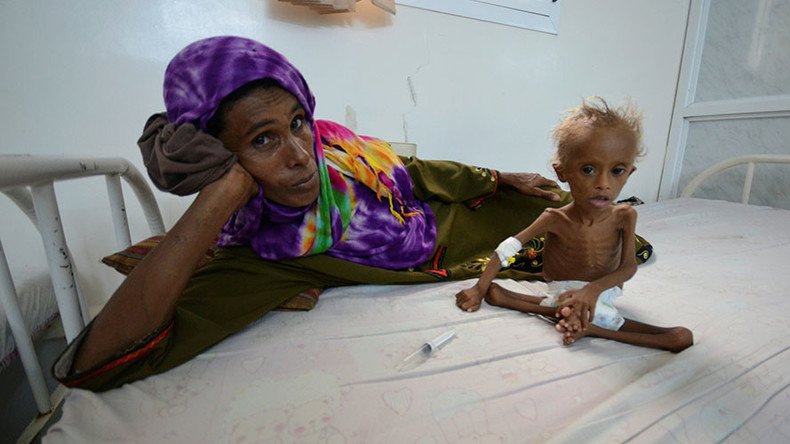 Shocking images of starved kid show horrors of Yemen’s civil war — RT ...