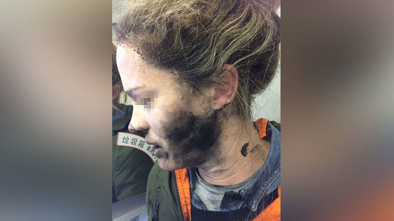 Mid-flight explosion of headphone battery leaves woman with facial burns (PHOTOS)