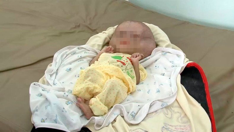 Infant deformities in Yemen linked to Saudi-led bombardment (GRAPHIC VIDEO)