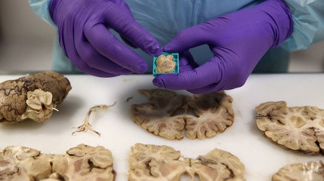 Brain protein may unlock key to multiple sclerosis treatment - study